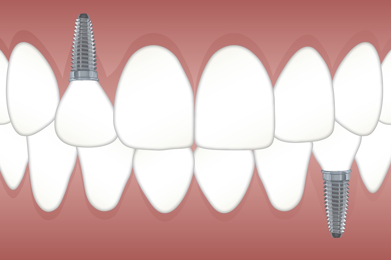 rechace implante dental