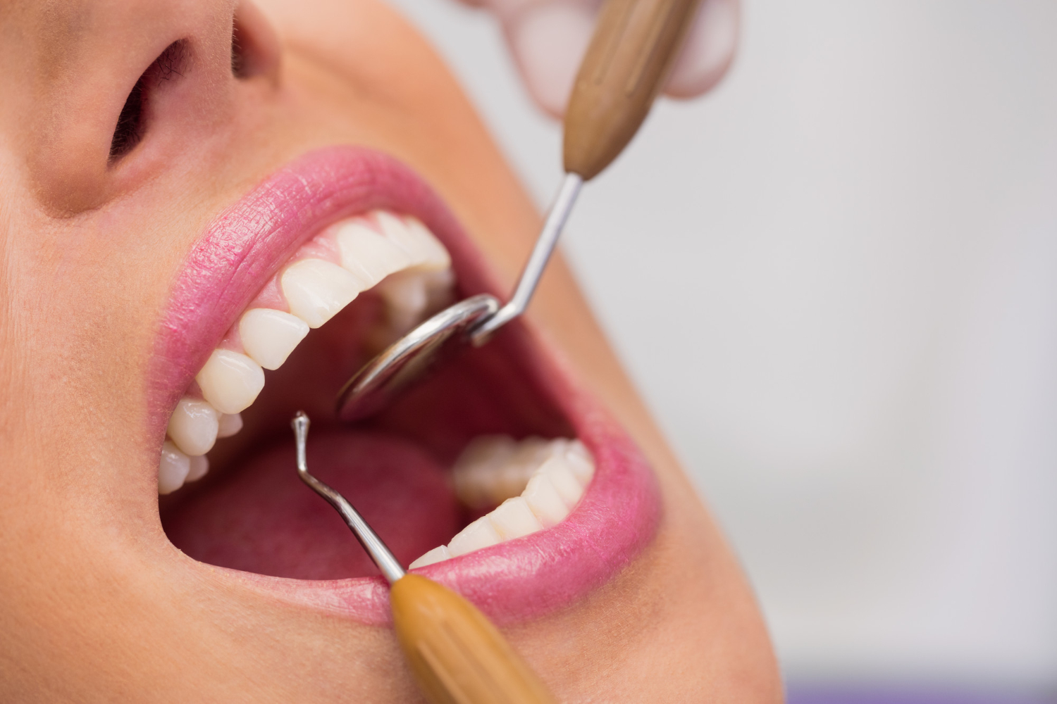 Raspado de encías - Precios endodoncia multirradicular - Clínica Dental Lavapiés