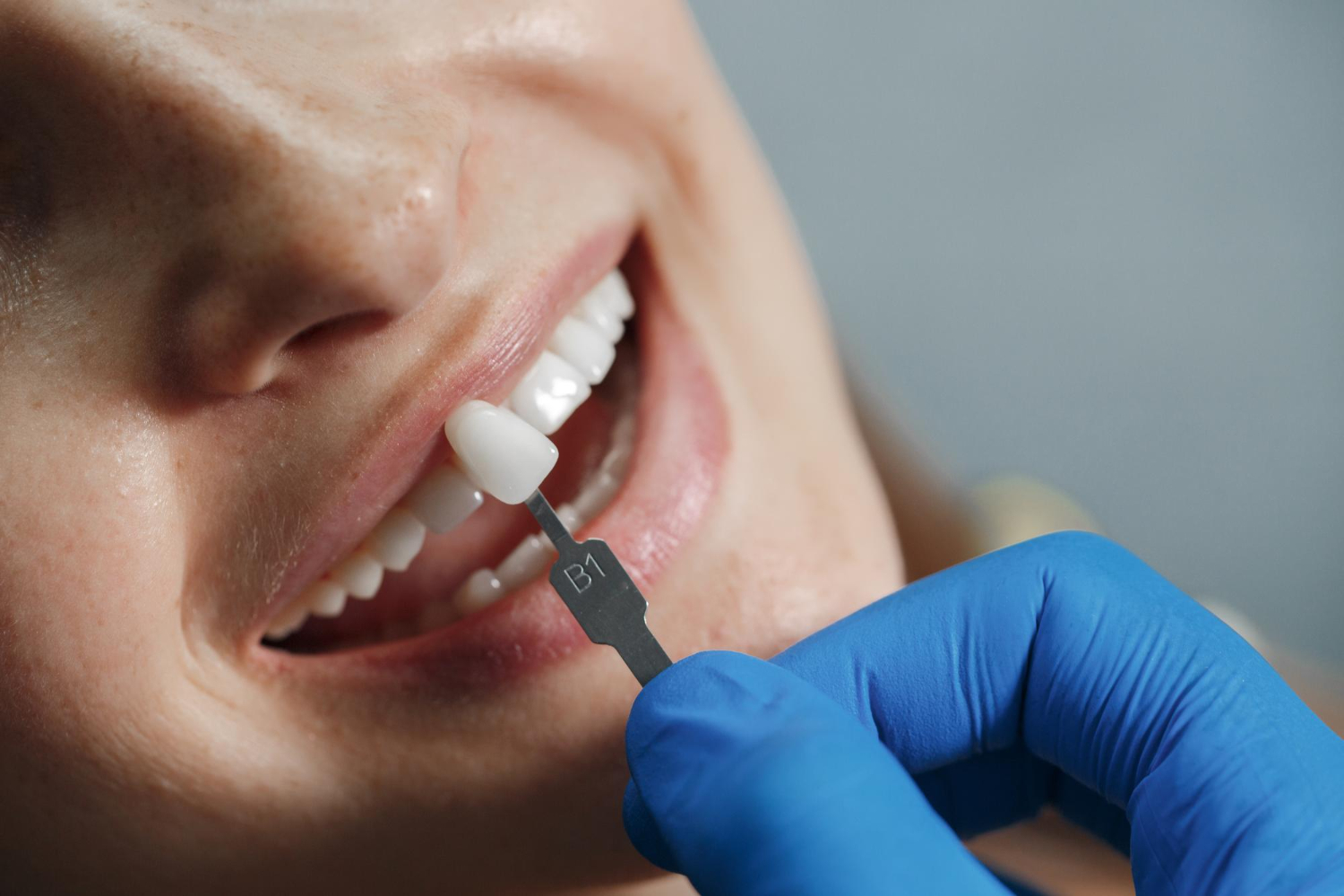 Cuidar fundas, carillas y microcarillas - Centro Dental Lavapiés