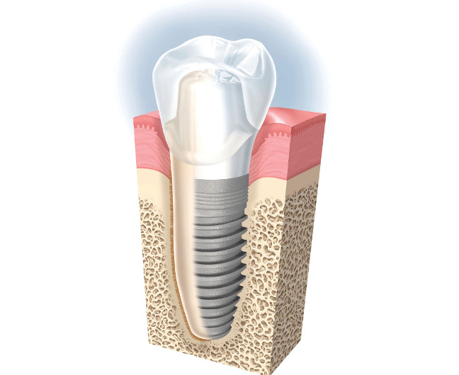 implantes dentales en el centro madrid