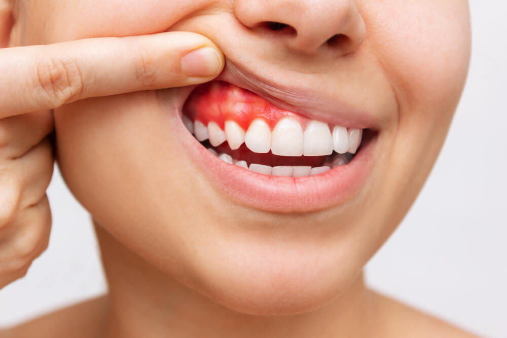 Inflamación de las encías - Centro Dental Lavapiés